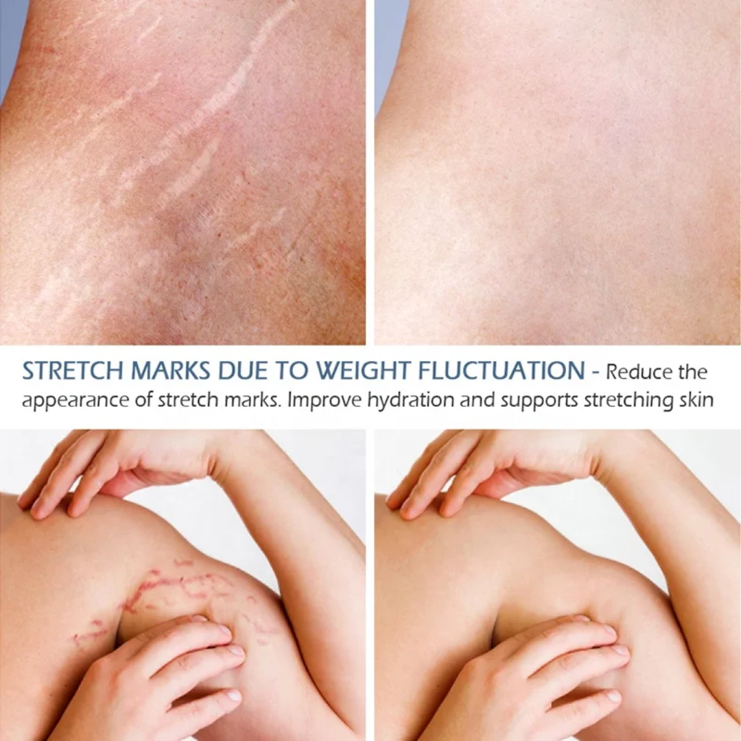 Stretch Mark Repair Treatment