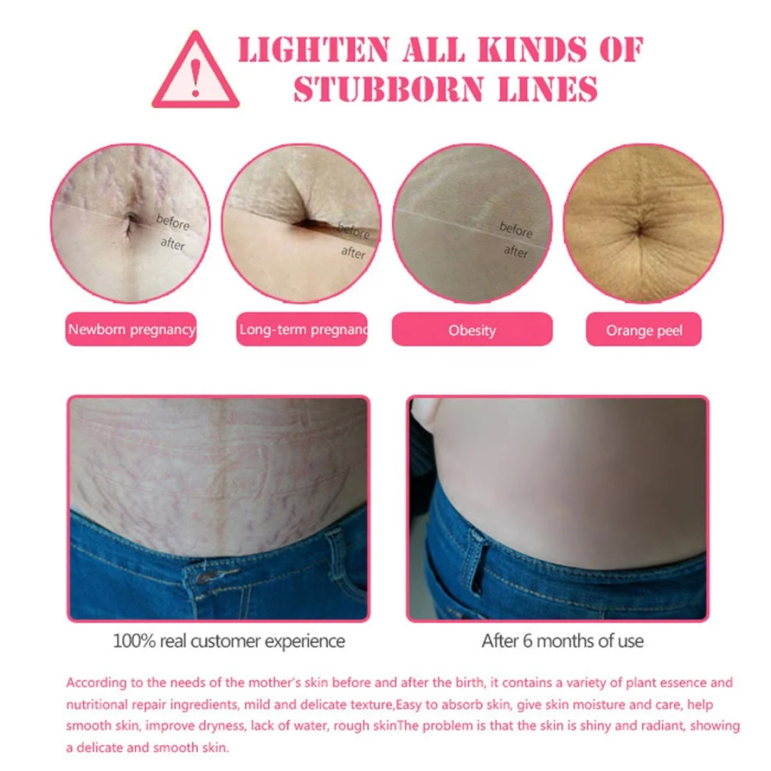 Stretch Mark Repair Treatment