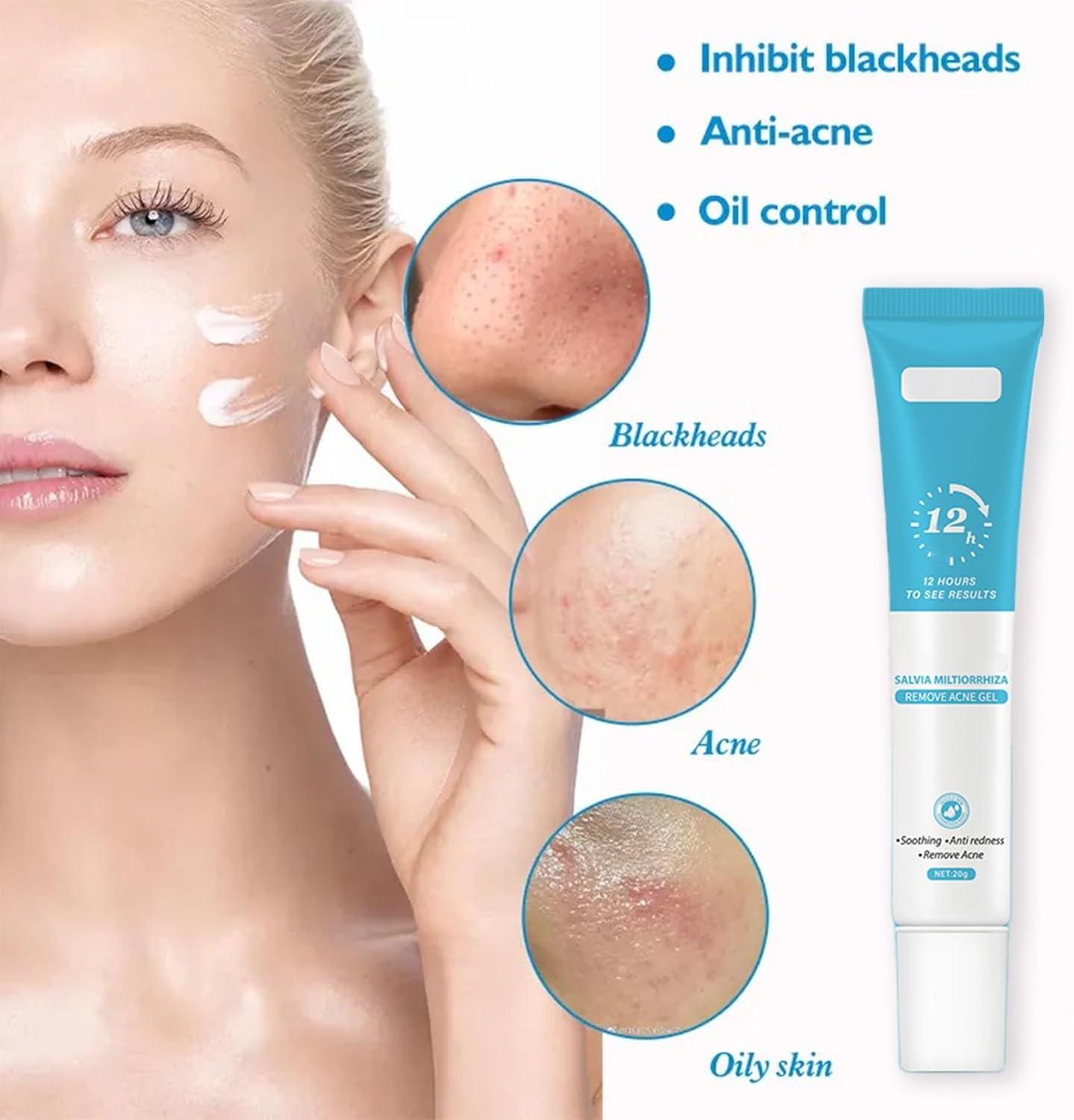 Clarifying Acne Treatment