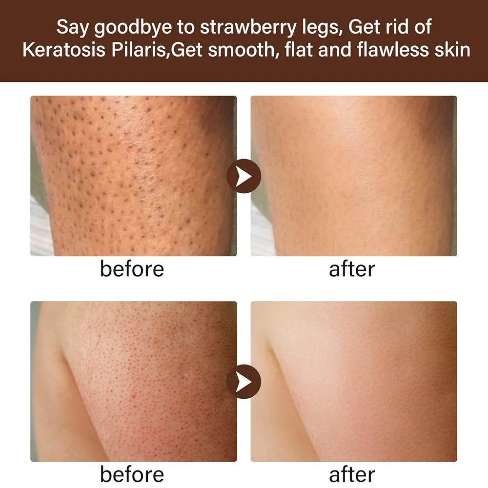 Pore-Refining Leg Treatment