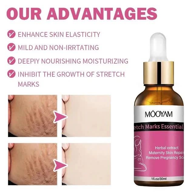 Stretch Mark Repair Treatment