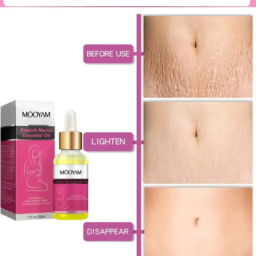 Stretch Mark Repair Treatment